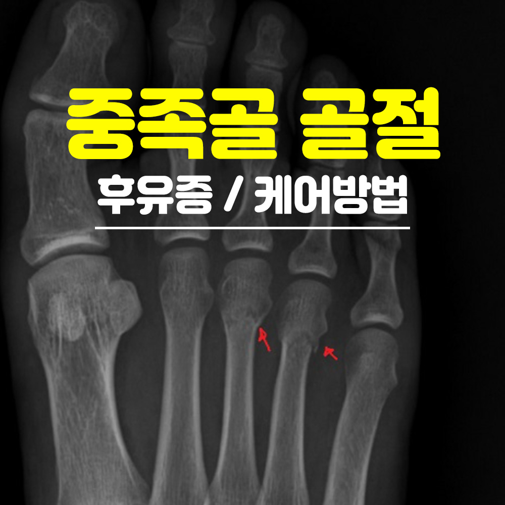 중족골 골절