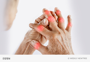 손가락 류마티스 관절염 증상