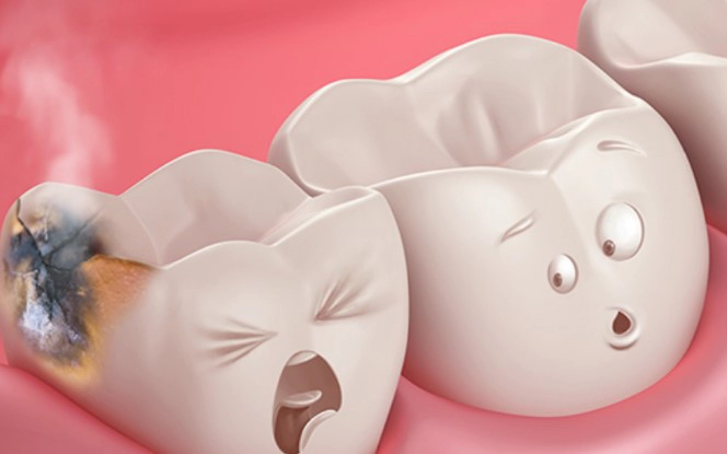 치아 우식단계별 증상 치료 