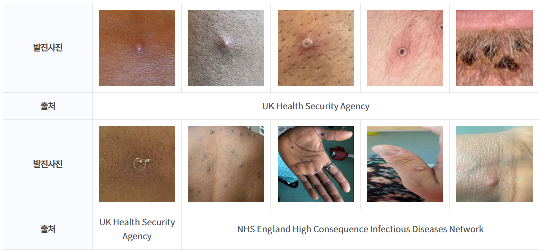 엠폭스원숭이두창