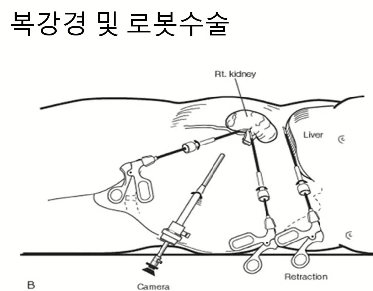 요로결석-명의-구교철-교수-복강경