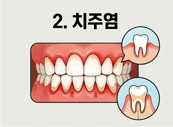 잇몸에서 피가 나는 이유