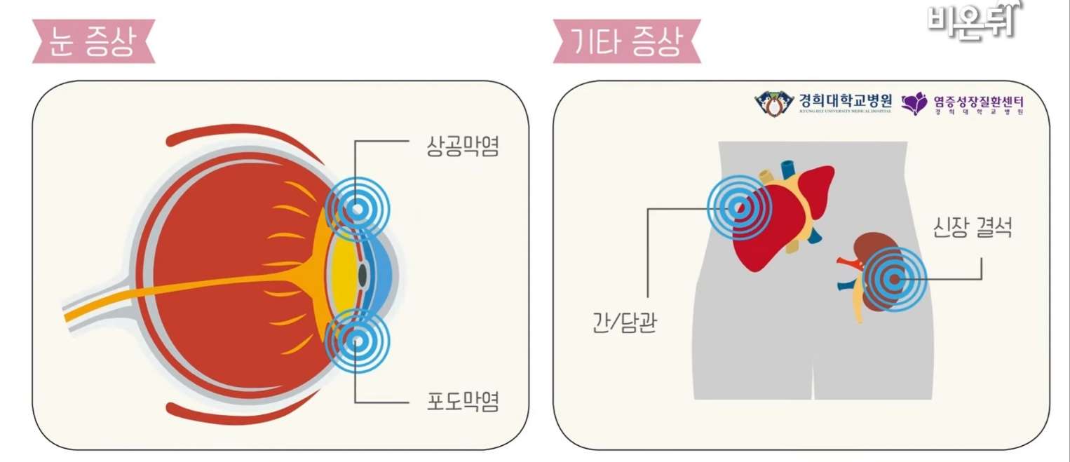 크론병 증상