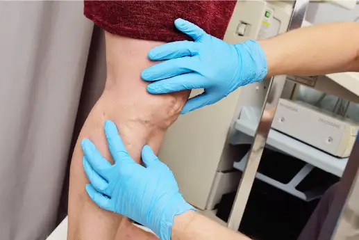 하지정맥류 초기 증상과 원인 치료방법