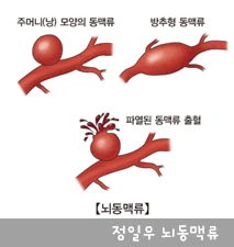 뇌동맥류 그림