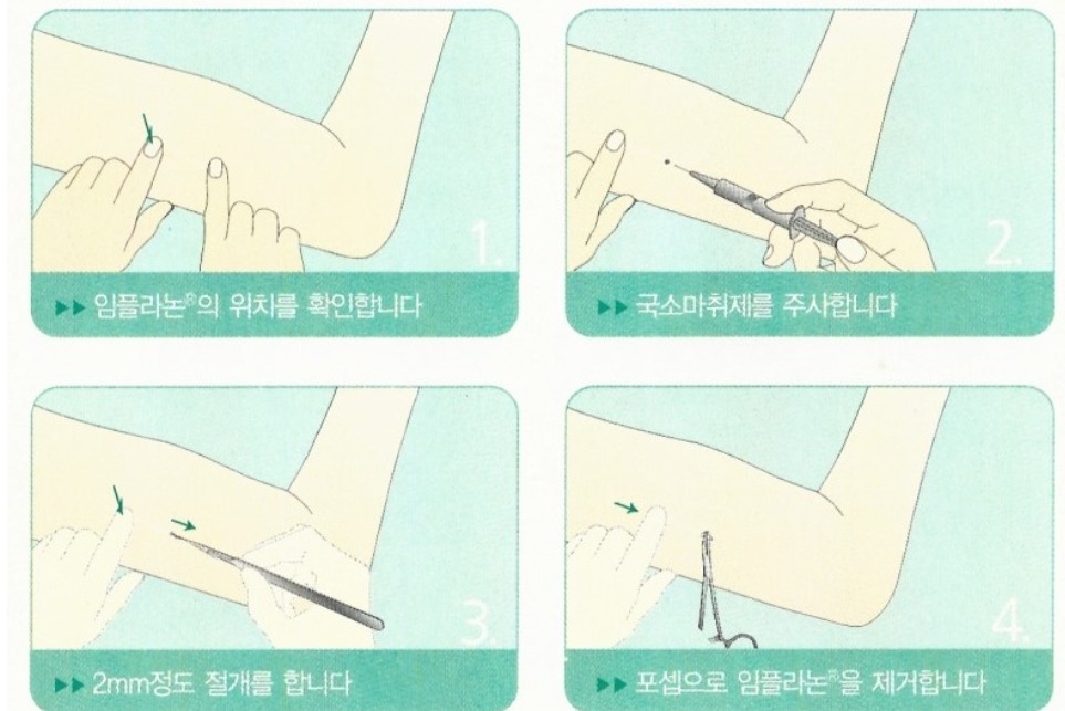 임플라논