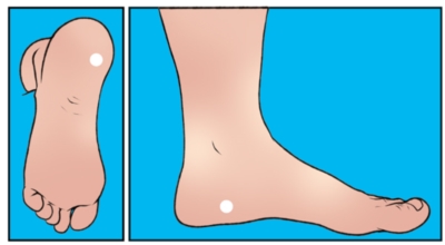 족저근막염 이미지