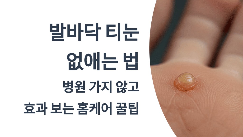 발바닥 티눈 없애는 법, 병원 가지 않고 효과 보는 홈케어 꿀팁