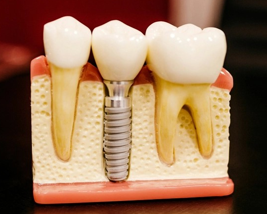 임플란트 비용 정리: 종류별 가격과 시술 기간