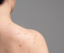 피부암 초기증상 17