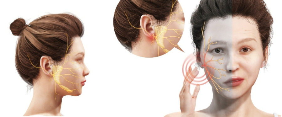 얼굴이 비뚫어지는 병인 구안와사의 원인과 증상을 그림으로 이미지화 한 사진