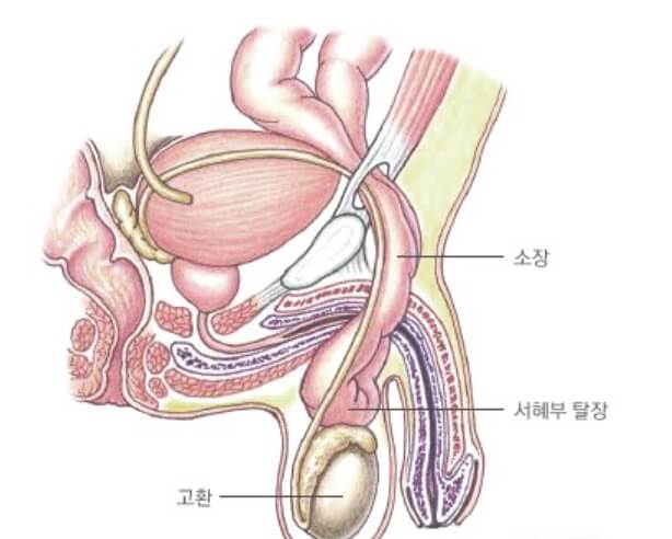 서혜부 탈장