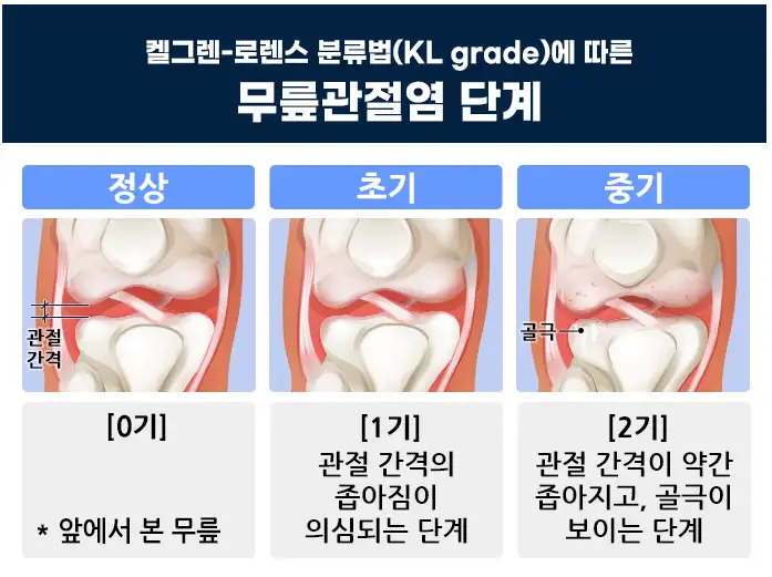 무릎관절염-정상초기중기-이미지
