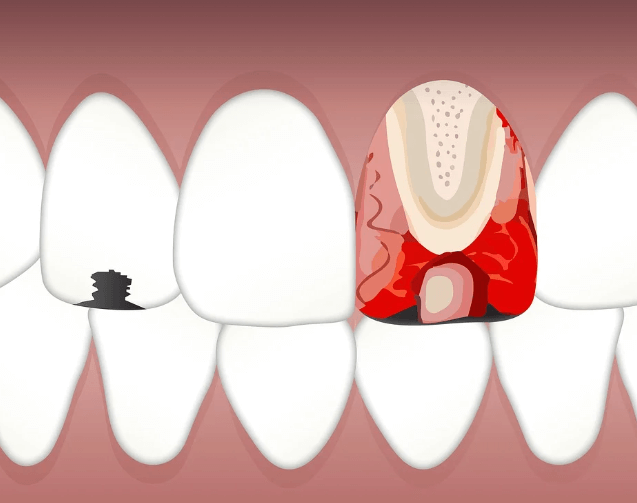 이빨 빠지는 꿈 해몽