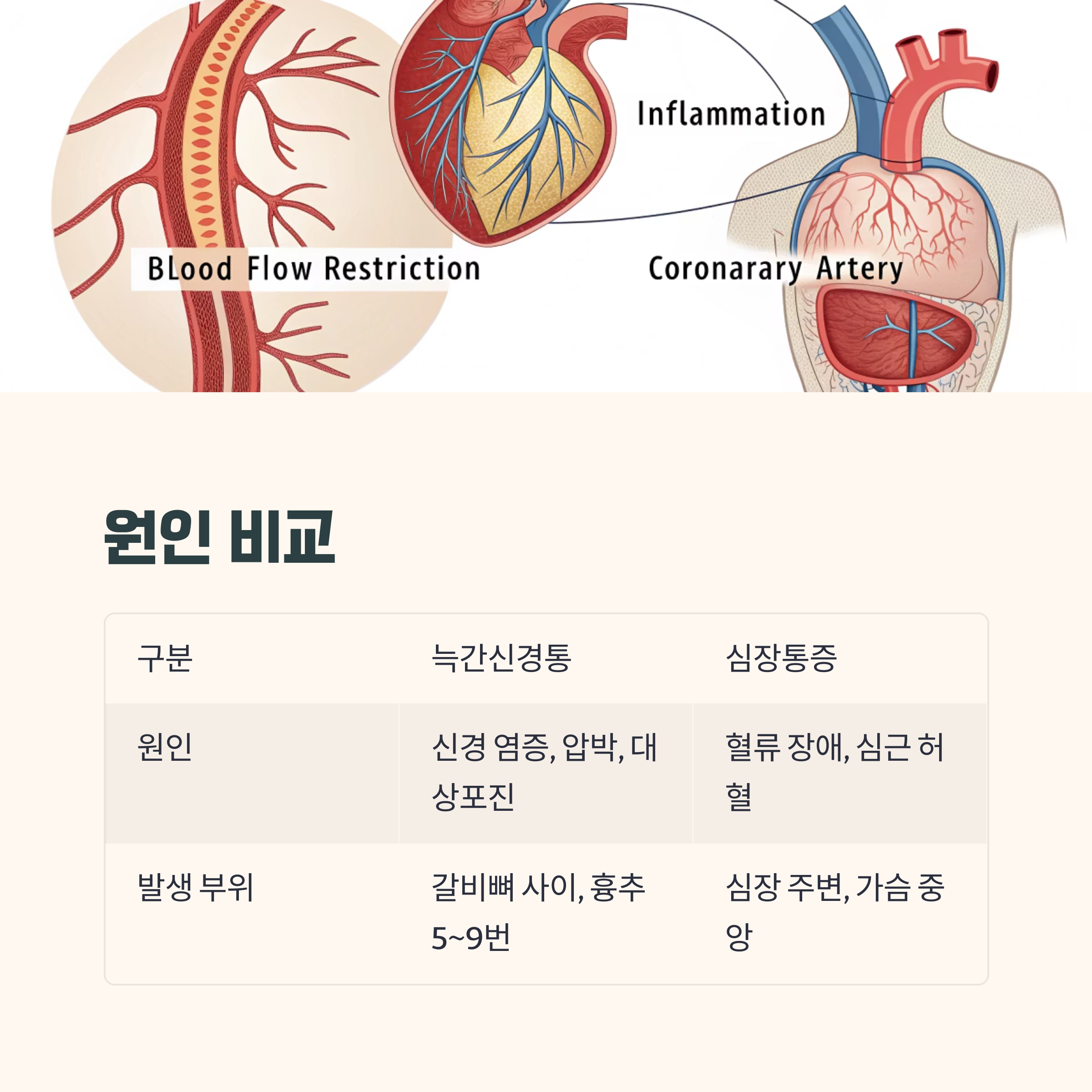 늑간신경통과 심장통증의 원인 비교