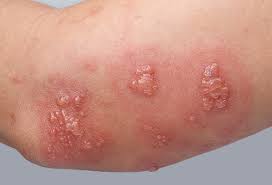 대상포진 초기증상과 치료법