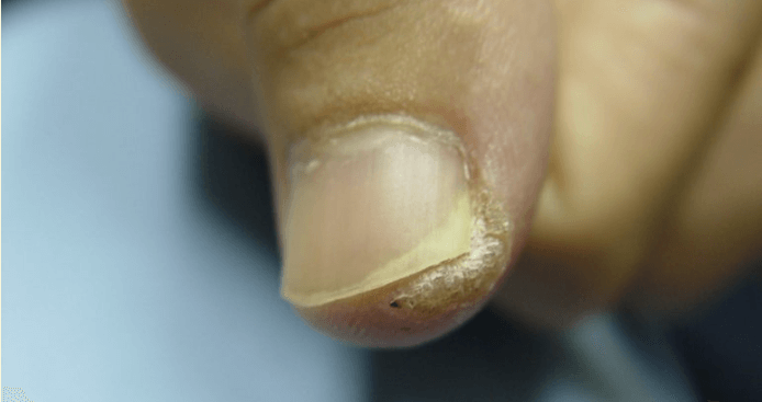 사마귀 완벽제거 방법&amp;#44;사마귀 생기는 이유&amp;#44;사마귀 종류 보통사마귀&amp;#44;사마귀 종류 편평사마귀&amp;#44;사마귀 종류 발바닥사마귀&amp;#44;사마귀 종류 성기사마귀&amp;#44;사마귀 종류 손발톱사마귀&amp;#44;집에서 사마귀 완벽제거하는 방법&amp;#44;집에서 사마귀 완벽제거하는 방법 살리실산 패치&amp;#44;집에서 사마귀 완벽제거하는 방법 살리실산 연고&amp;#44;사마귀연고 사용방법&amp;#44; 사마귀 완벽제거 방법 냉동치료&amp;#44; 사마귀 완벽제거 방법 레이저 치료&amp;#44;사마귀 완벽제거 방법 전기 소작법&amp;#44;사마귀 완벽제거 방법 수술적 제거&amp;#44; 사마귀 완벽제거 방법 면역치료&amp;#44; 사마귀 완벽제거 후 관리법&amp;#44; 사마귀 예방법&amp;#44;사마귀 예방법 손씻기&amp;#44;사마귀 예방법 발씻기&amp;#44; 사마귀 예방법공용물건사용 피하기&amp;#44; 사마귀 예방법 피부상처 관리&amp;#44; 사마귀 예방법 면연력 유지&amp;#44; 사마귀 예방법 성기 사마귀 예방&amp;#44; 성기사마귀 예방법 콘돔&amp;#44; 성기사마귀 예방법 HPV백신 접종&amp;#44; HPV 백신&amp;#44; 자궁경부암 예방