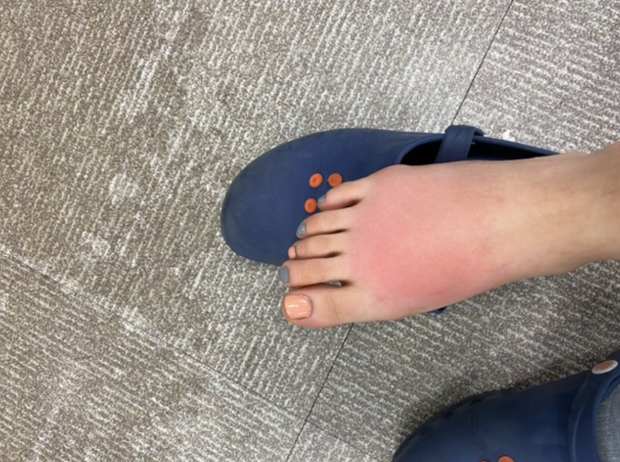 봉와직염 의심사진