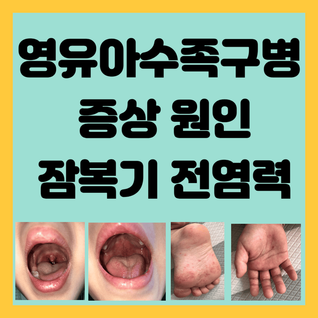 영유아수족구병 증상 원인 잠복기 전염력