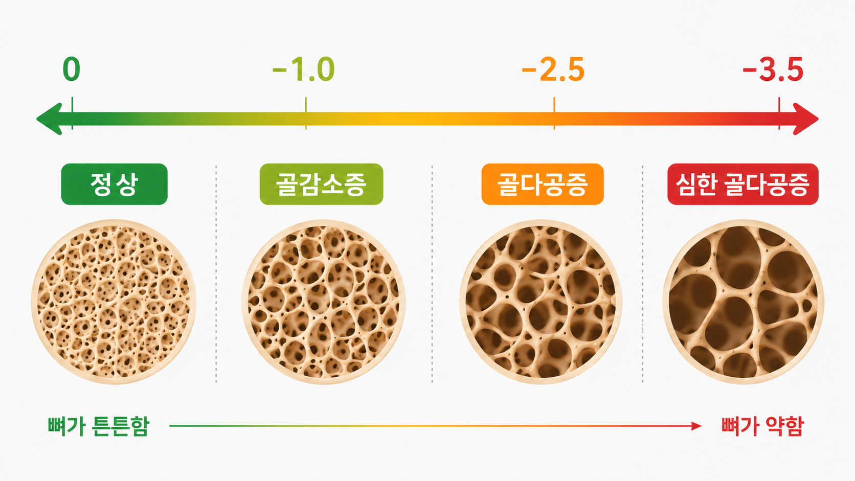 골다공증 수치