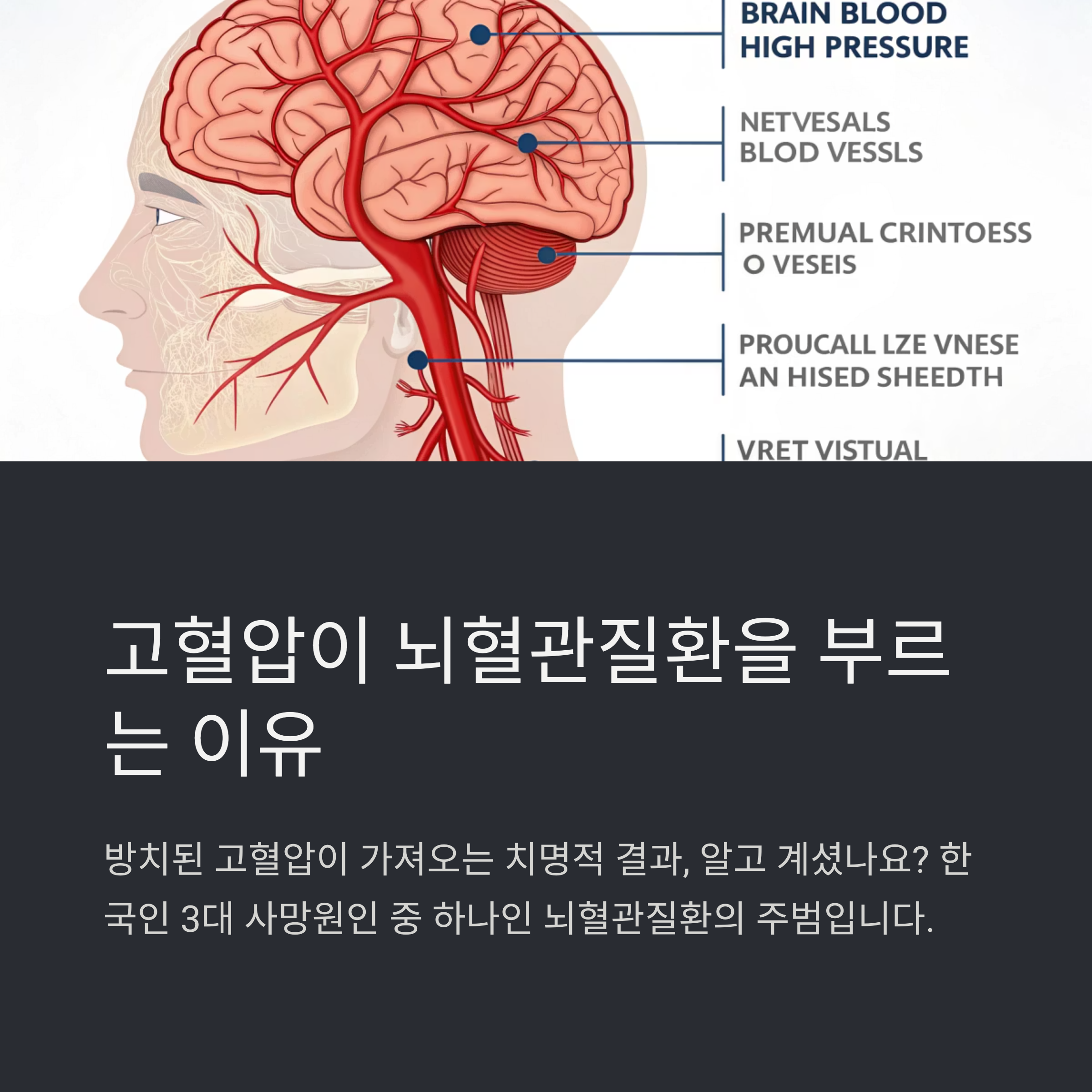 뇌혈관질환
