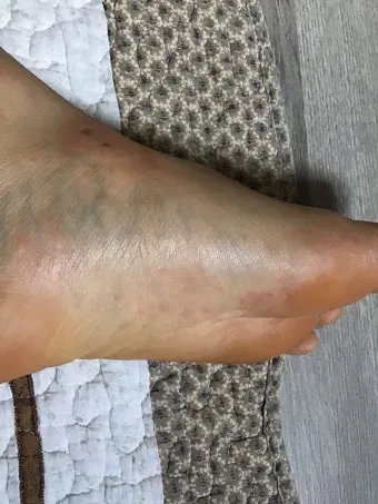 침구 진드기 햇볕 건조와 고온 살균 보관법_7