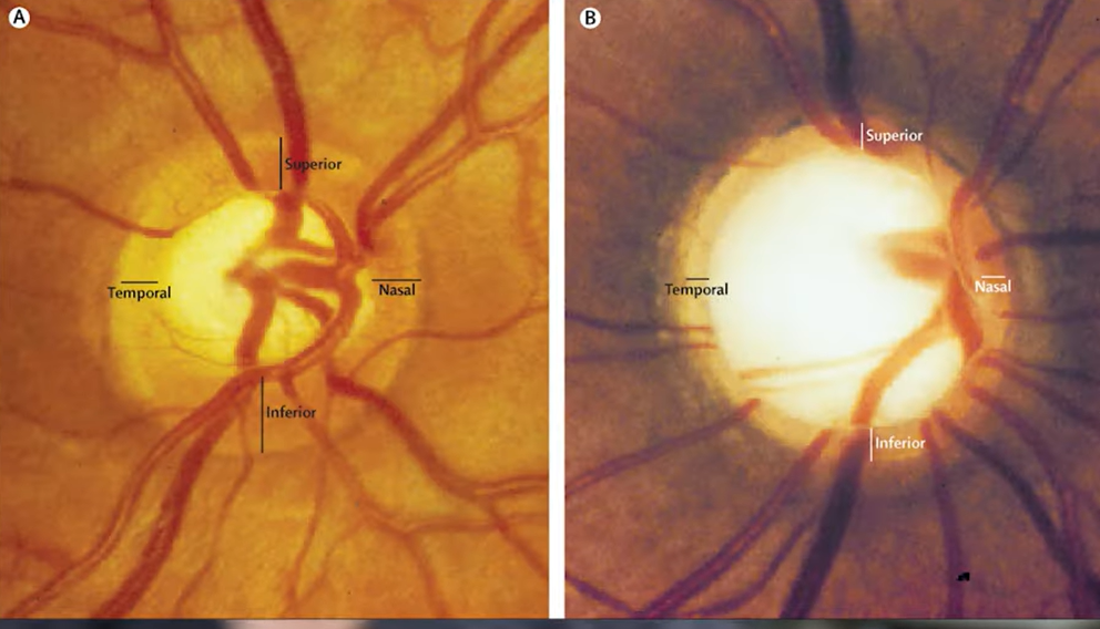 녹내장 초기증상