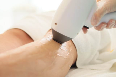 종아리 레이저 제모 시술