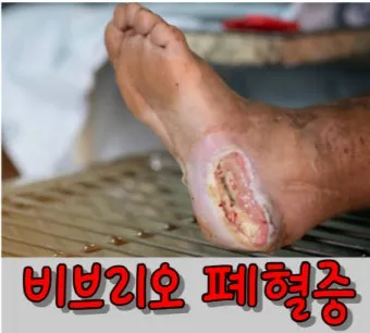 패혈증이란 무엇인지 원인 증상 치료 예방법_20