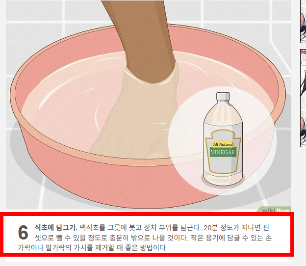 손가락 가시 빼는법 소개