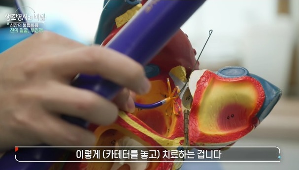 생로병사의비밀-부정맥-정보영-교수