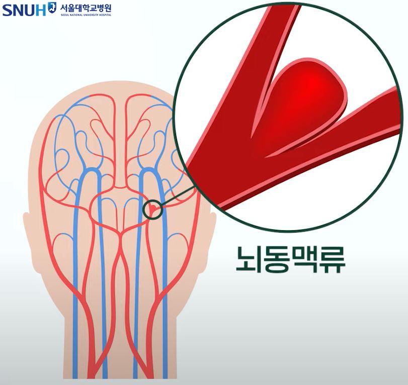 뇌동맥류 증상