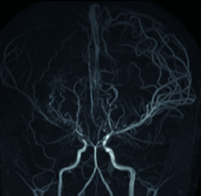 모야모야병 증상 원인 치료방법 관리