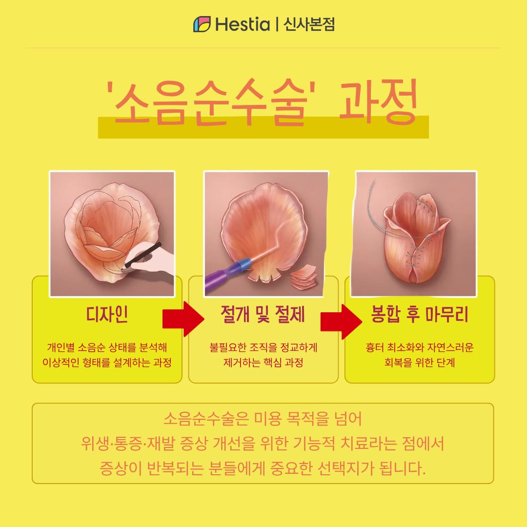 소음순수술 과정