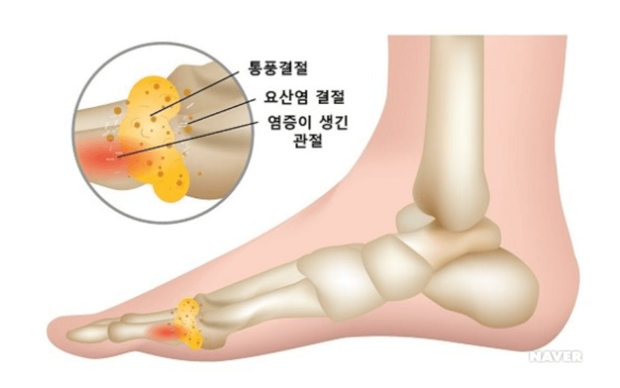 엄지발가락 관절에 노란 요산이 쌓인 발 옆모습