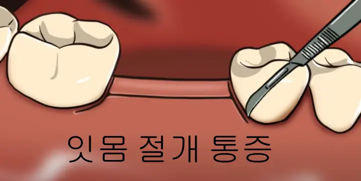 잇몸-절개-사진