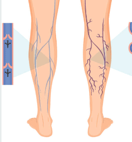 하지 정맥류 증상 수술비용