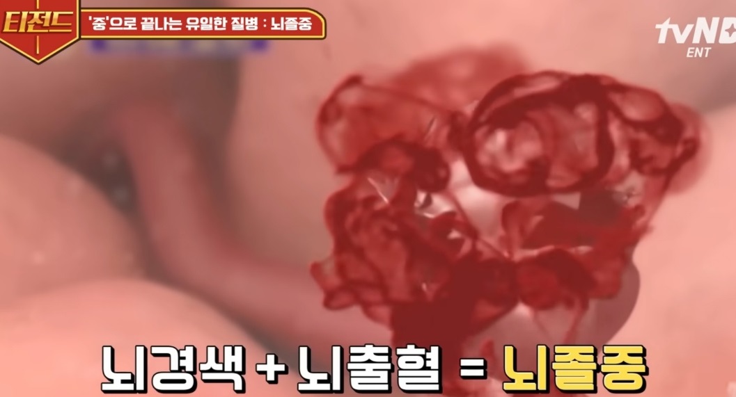 EBS명의-뇌졸중-명의-백남종-교수