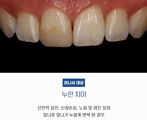 누런 치아