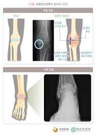 관절경수술 후 물리치료 운동 가이드