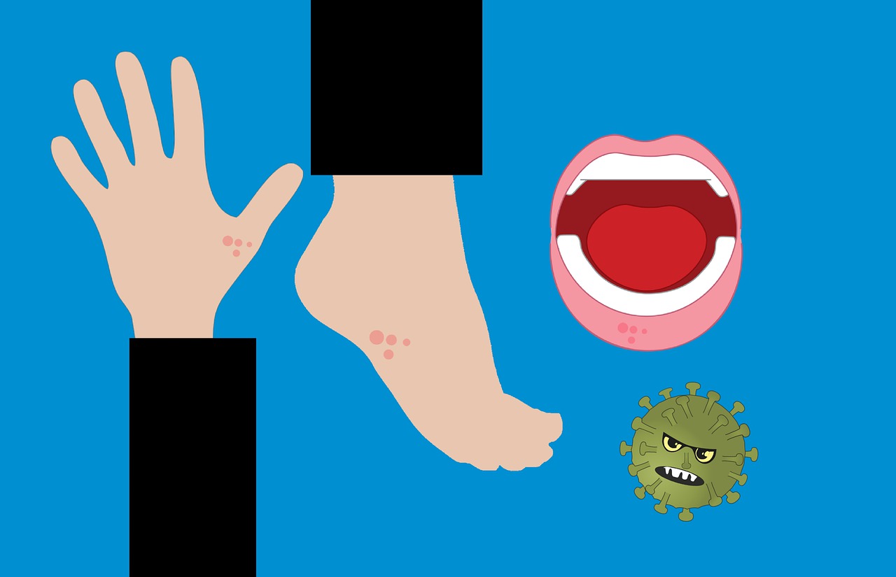 수족구 바이러스로 인한 손과 발 그리고 입안 발진