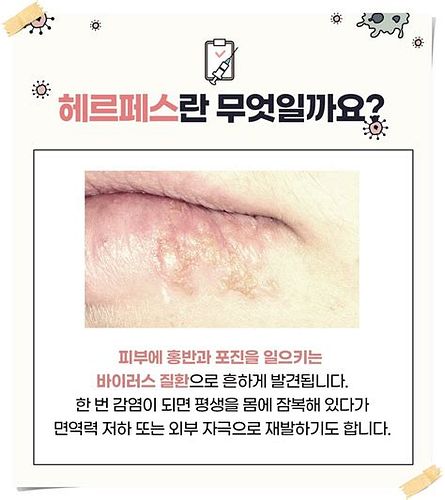 성병증상