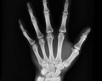 다발성골수종의 원인과 증상 치료 방법