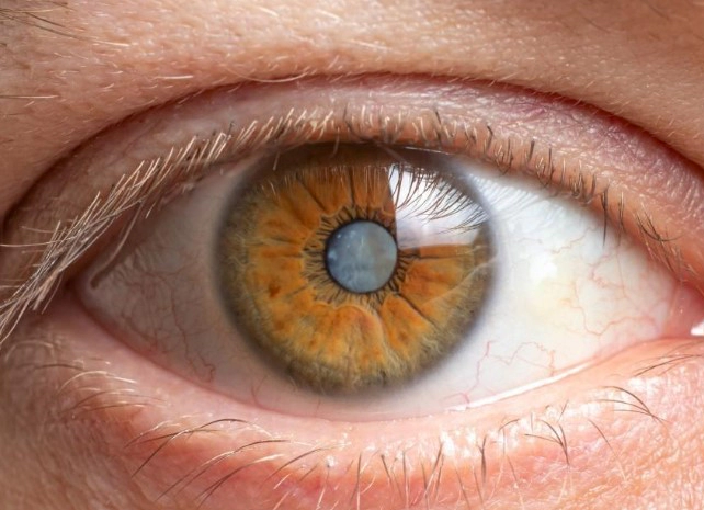 백내장 증상 6가지 및 백내장 수술비용 및 시력회복 기간 총정리 (자주묻는질문)