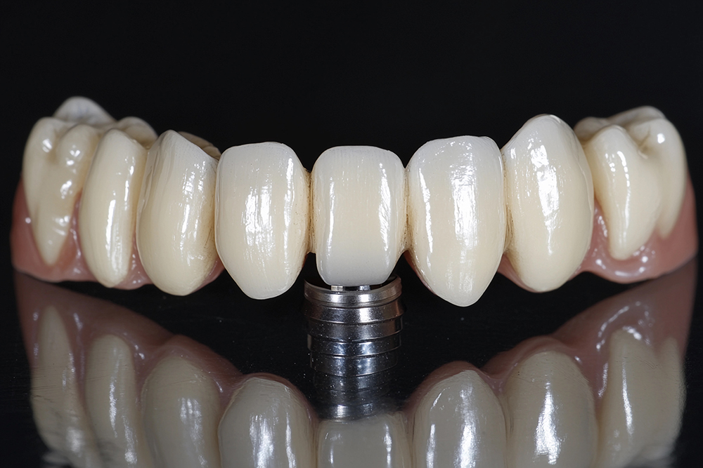 전체 임플란트 가격