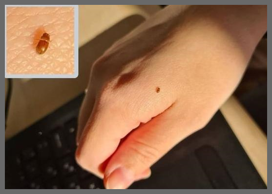 권연벌레 물린자국 퇴치법