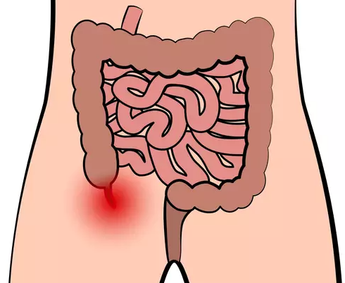 맹장염 복강경 수술 비용