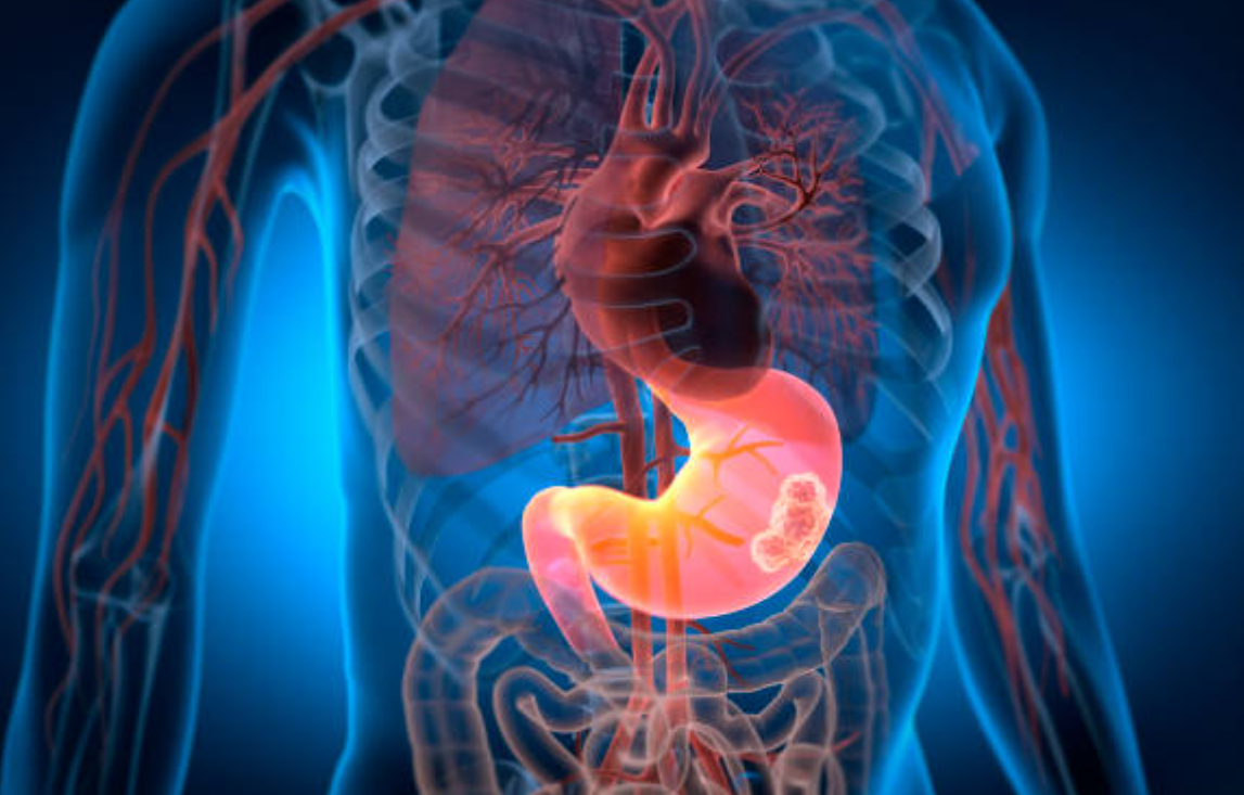 위암과 관련된 사진1