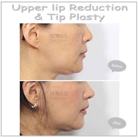 인중 축소 수술