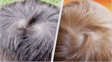 모발의 종류와 형태-whorl